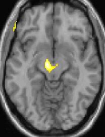 Kernspin-Auswertung (VBM), waagerechter Schnitt: gelber Fleck in der Hirnmitte im Bereich des Hypothalamus.