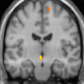 PET-Aufnahme, Querschnitt von vorn: Ein gelber Fleck in der Mitte unter den Hirnkammern zeigt das während der Attacke aktive Areal im Bereich des Hypothalamus, dazu kleinere Flecken in der Hirnrinde.