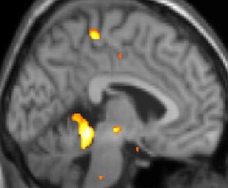 PET-Aufnahme, Längsschnitt durch das Gehirn: Gelb-orange Flecken zeigen Areale, die während der Attacke stärker arbeiten, darunter ein deutlicher Fleck tief in der Hirnmitte im Bereich des Hypothalamus.