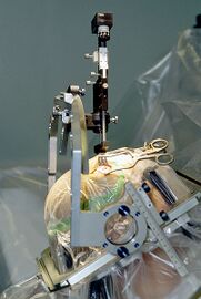 Kopf eines Patienten in einem am Schädel befestigten Metallrahmen mit Zielvorrichtung, im Operationssaal.