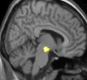 Kernspin-Auswertung (VBM), Längsschnitt: Ein einziger gelber Fleck in der Hirnmitte markiert den Bereich des Hypothalamus, in dem sich das Gehirn Betroffener unterschied.