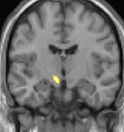 Kernspin-Auswertung (VBM), Querschnitt von vorn: ein einziger gelber Fleck in der Mitte unter den Hirnkammern, im Bereich des Hypothalamus.